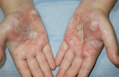 Finger lesions caused by the herpes simplex virus often resemble pyogenic infection and must be differentiated from the latter to avoid unnecessary surgical drainage. . Herpes on hands treatment